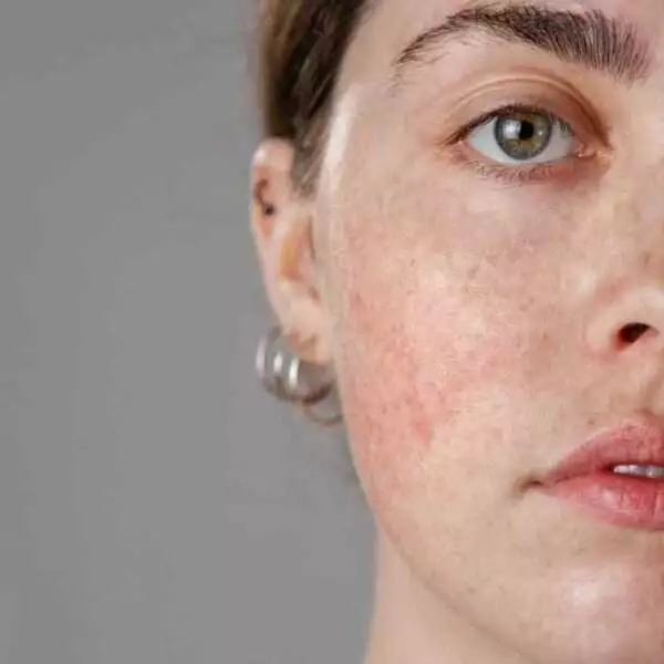 RF-Reduces-Vessel-Density-and-Inflammation-in-Rosacea-prone-Skin_11zon-600x600